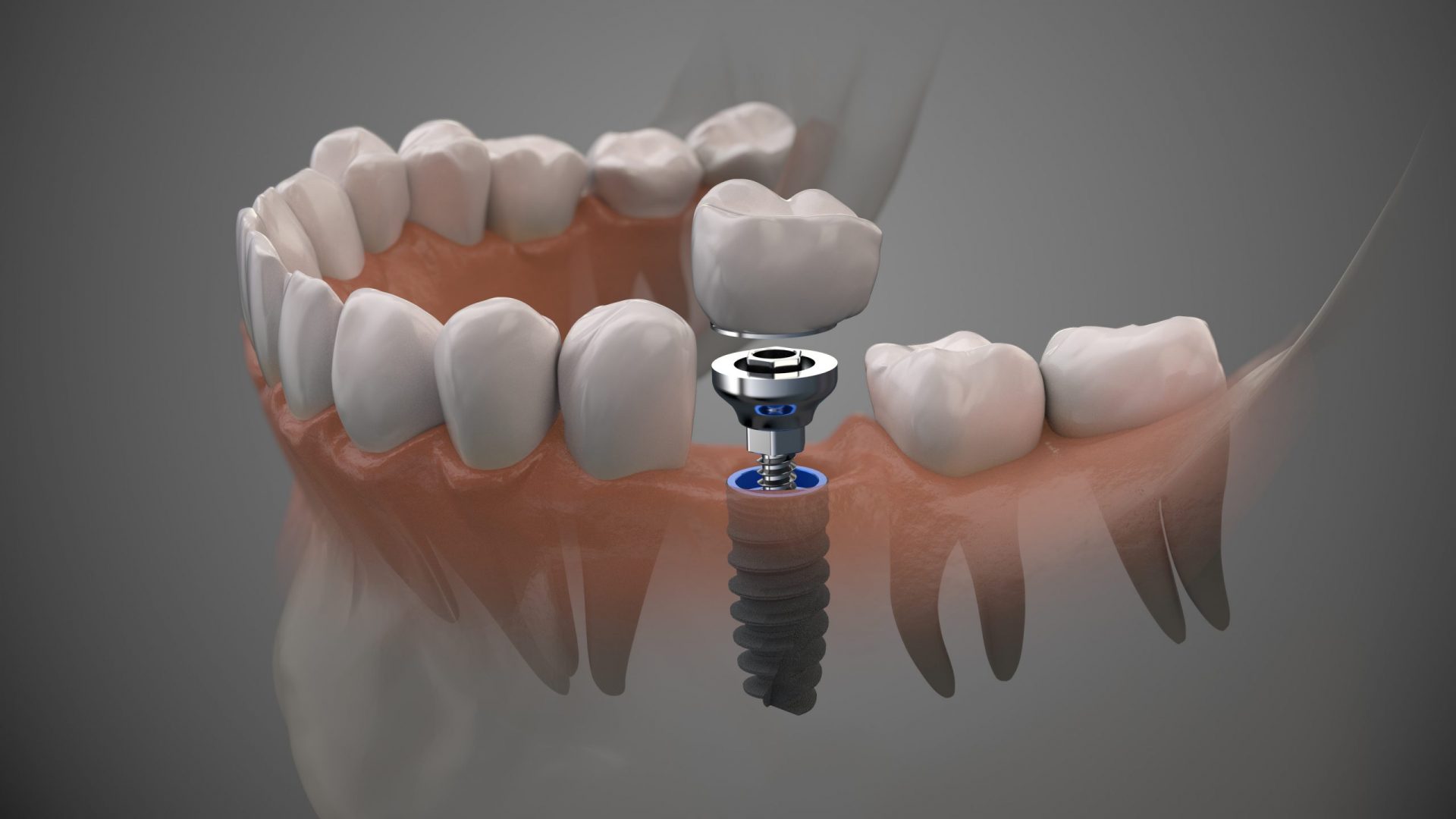 Navigating the Process of Dental Implants in Melbourne: A Comprehensive Guide