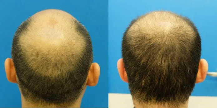 Dispelling Common Myths About Topical Finasteride for Hair Loss