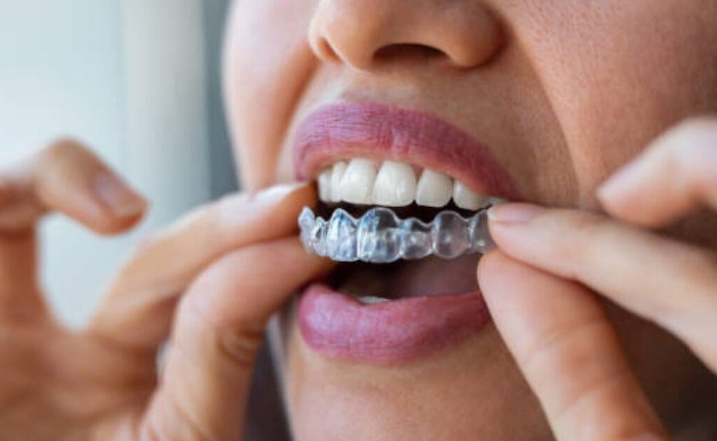 The Hidden Lifestyle Benefits of Choosing Invisalign Over Conventional Braces