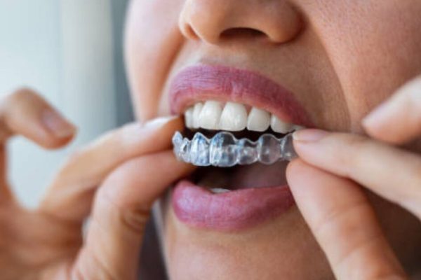 The Hidden Lifestyle Benefits of Choosing Invisalign Over Conventional Braces