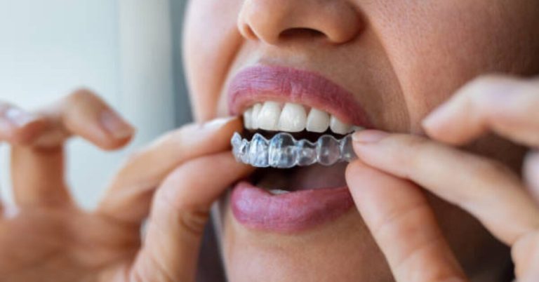 The Hidden Lifestyle Benefits of Choosing Invisalign Over Conventional Braces